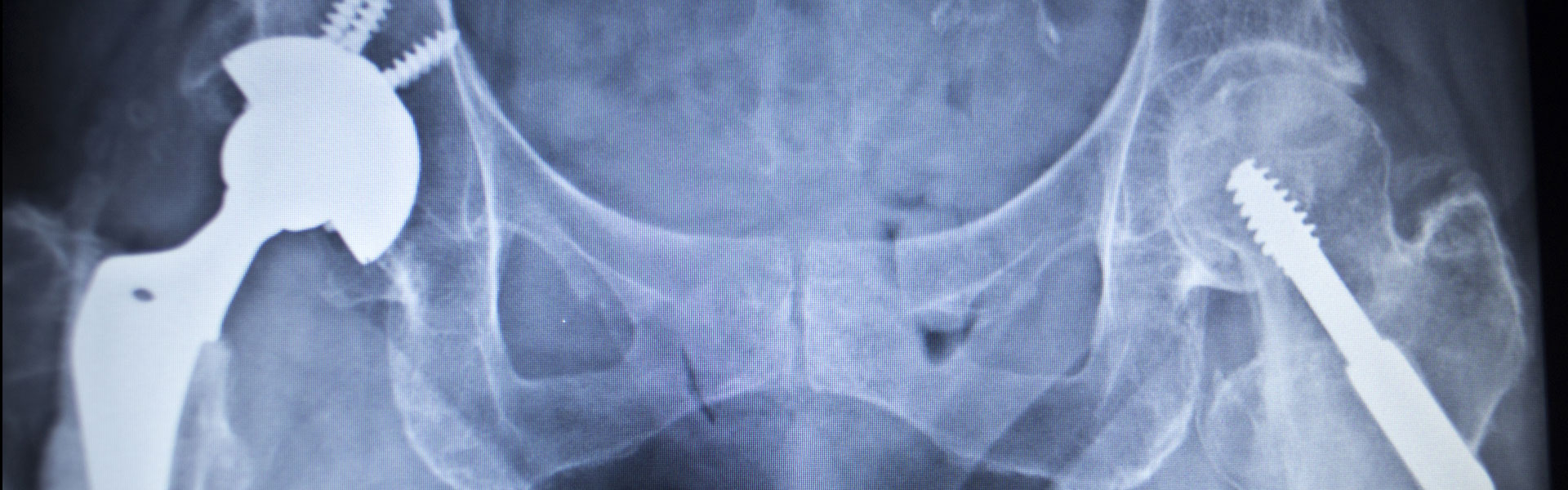 Defective Hip Implant Lawyers Depuy & Stryker Hip Injury Lawsuits